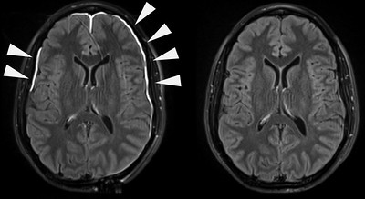Image of scan showing damage from a mild TBI appearing as bright areas around the perimeter of the brain pointed out by arrows