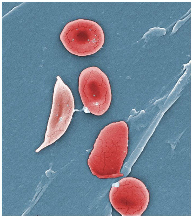 Normal round blood cells under a microscope along with a sickle cell which is shaped like a banana
